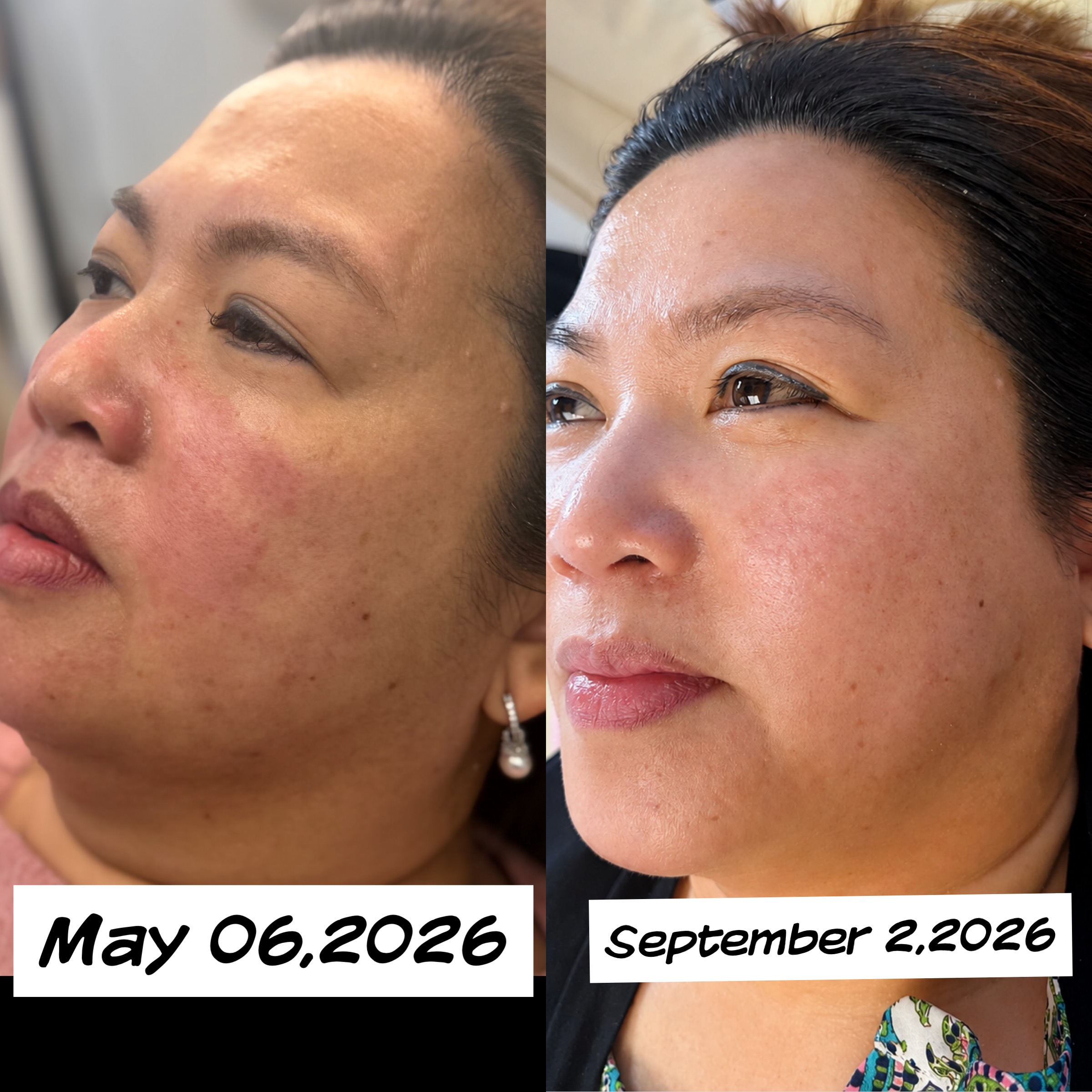 Facials & Peels before and after, GlowHaus Skin & Wellness, Allen TX