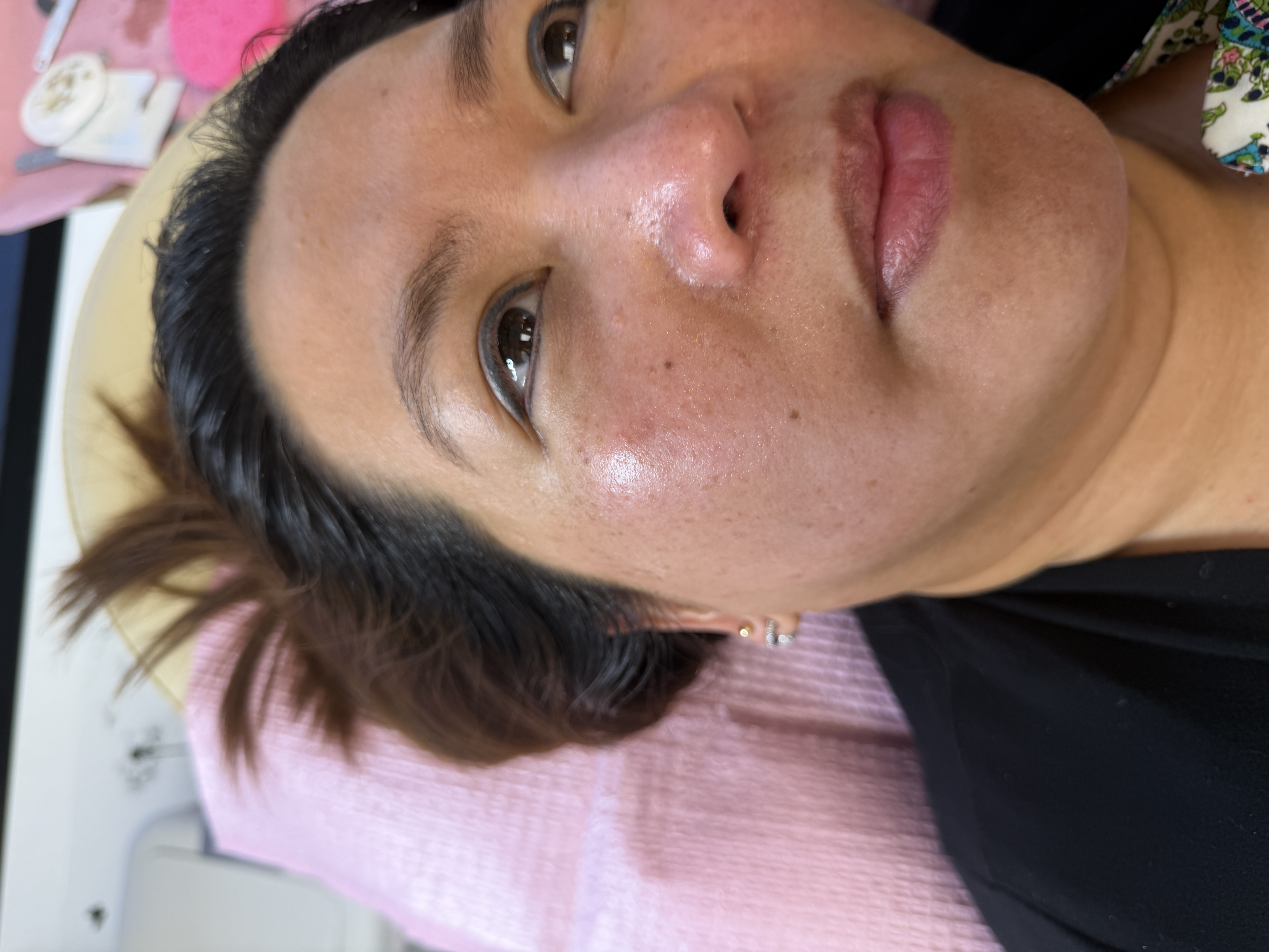 Facials & Peels before and after, GlowHaus Skin & Wellness, Allen TX