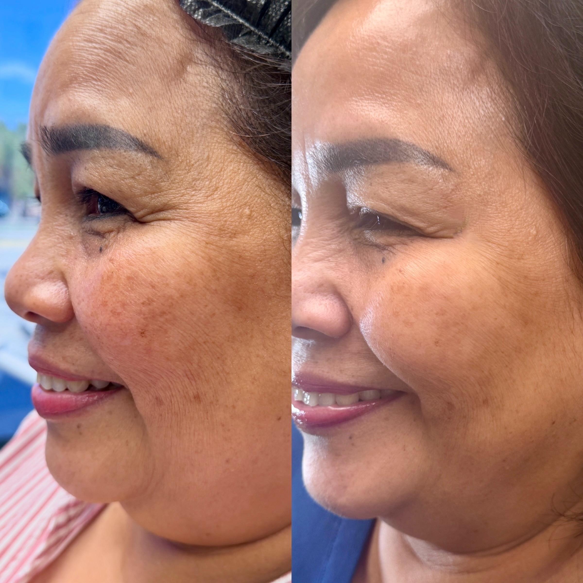 Facials & Peels before and after, GlowHaus Skin & Wellness, Allen TX