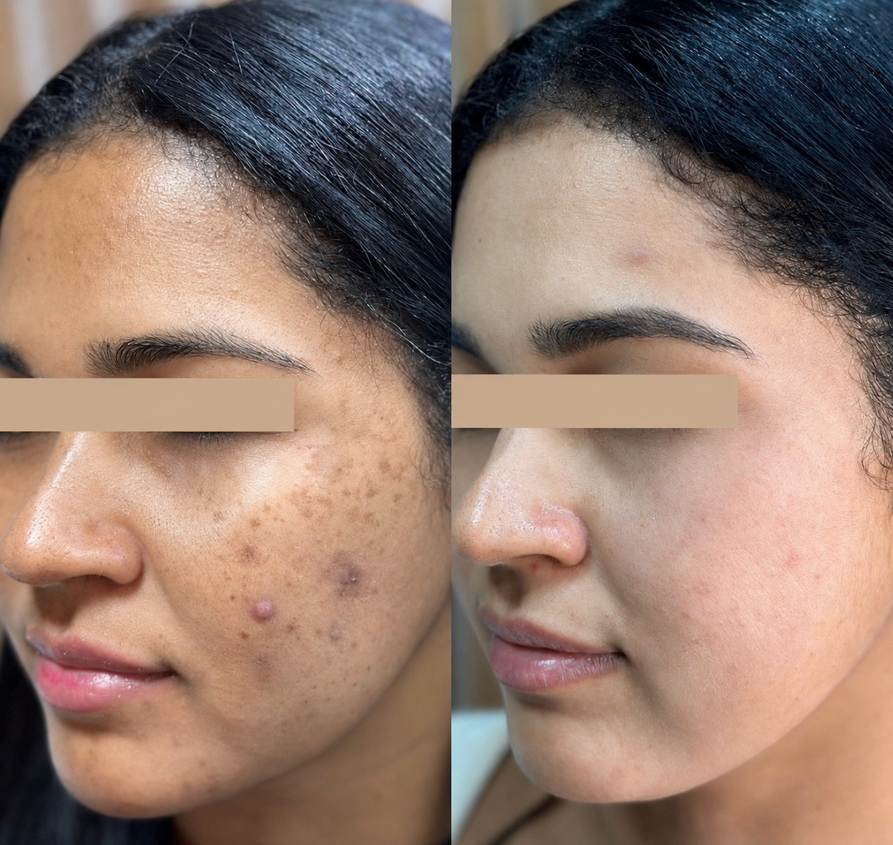 Facials & Peels before and after, GlowHaus Skin & Wellness, Allen TX