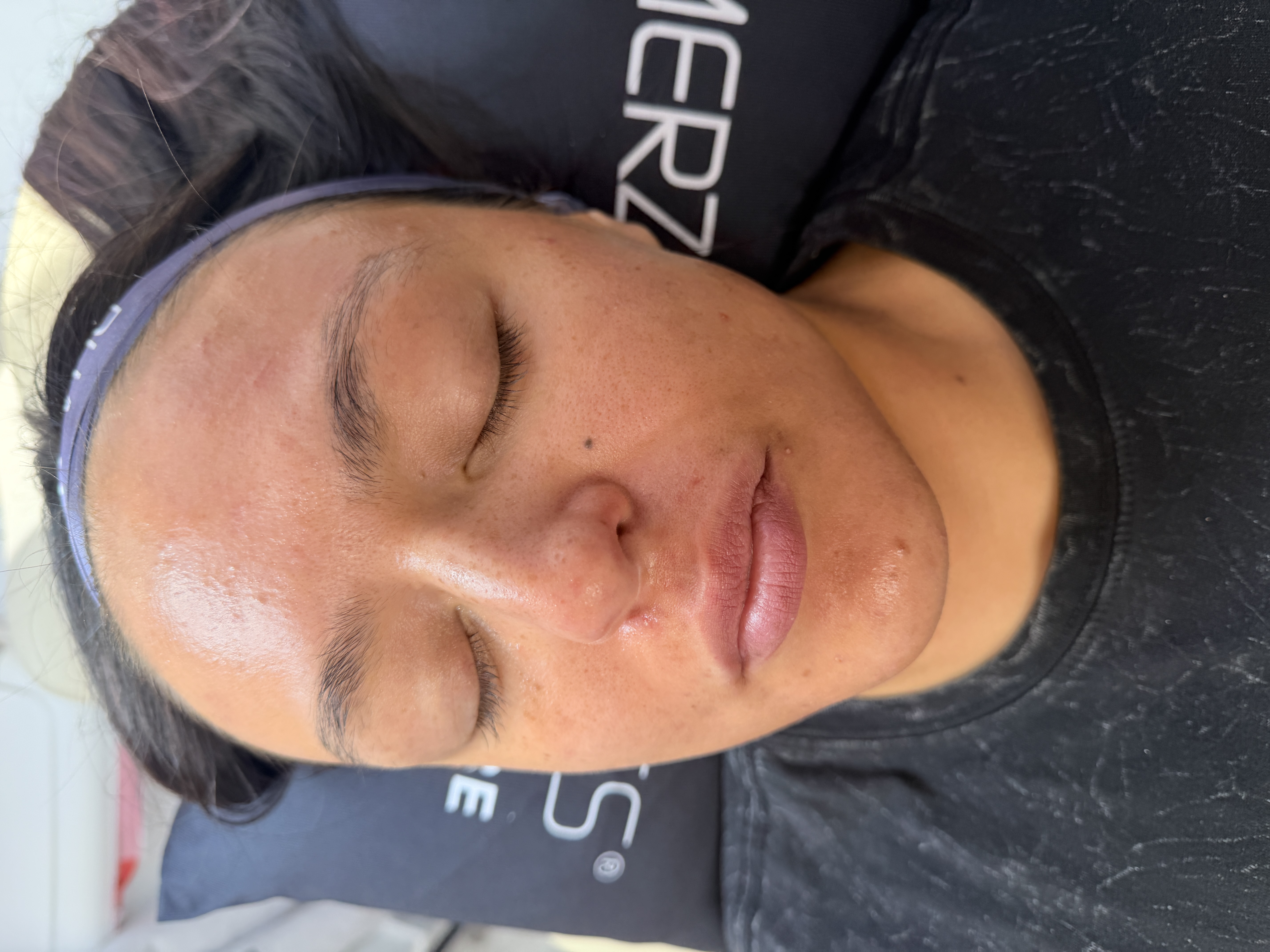 Facials & Peels before and after, GlowHaus Skin & Wellness, Allen TX