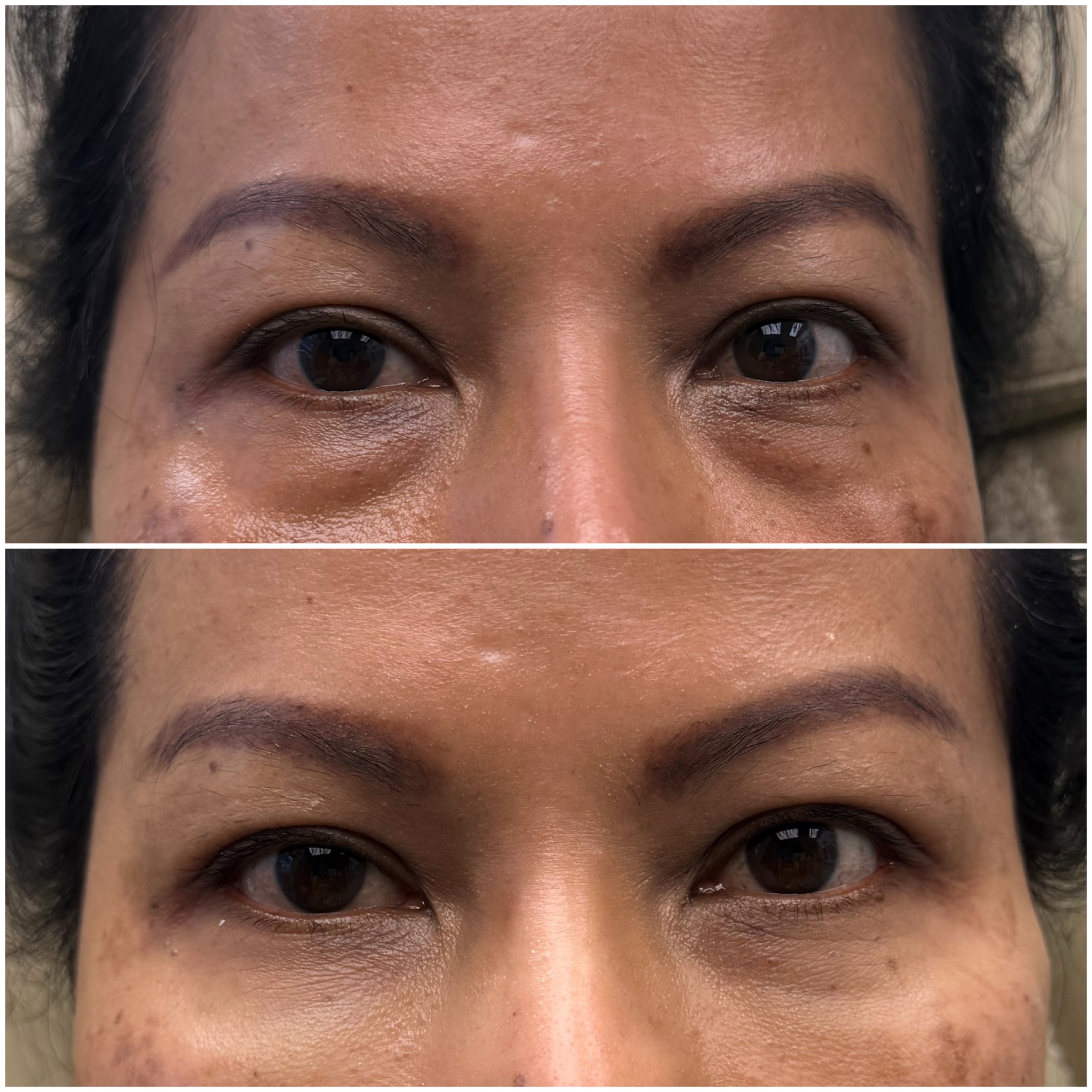 PRP before and after, GlowHaus Skin & Wellness, Allen TX