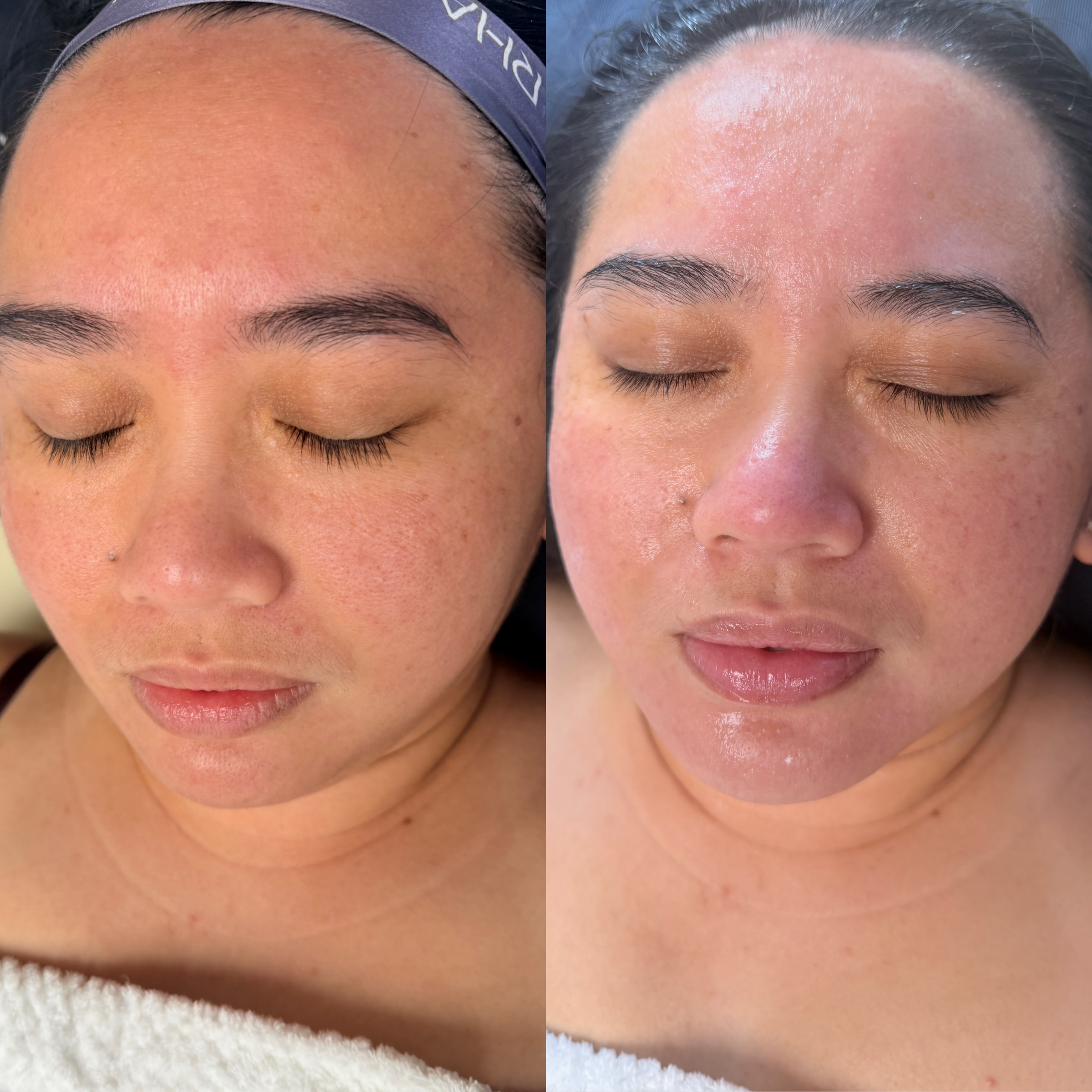 Facials & Peels before and after, GlowHaus Skin & Wellness, Allen TX