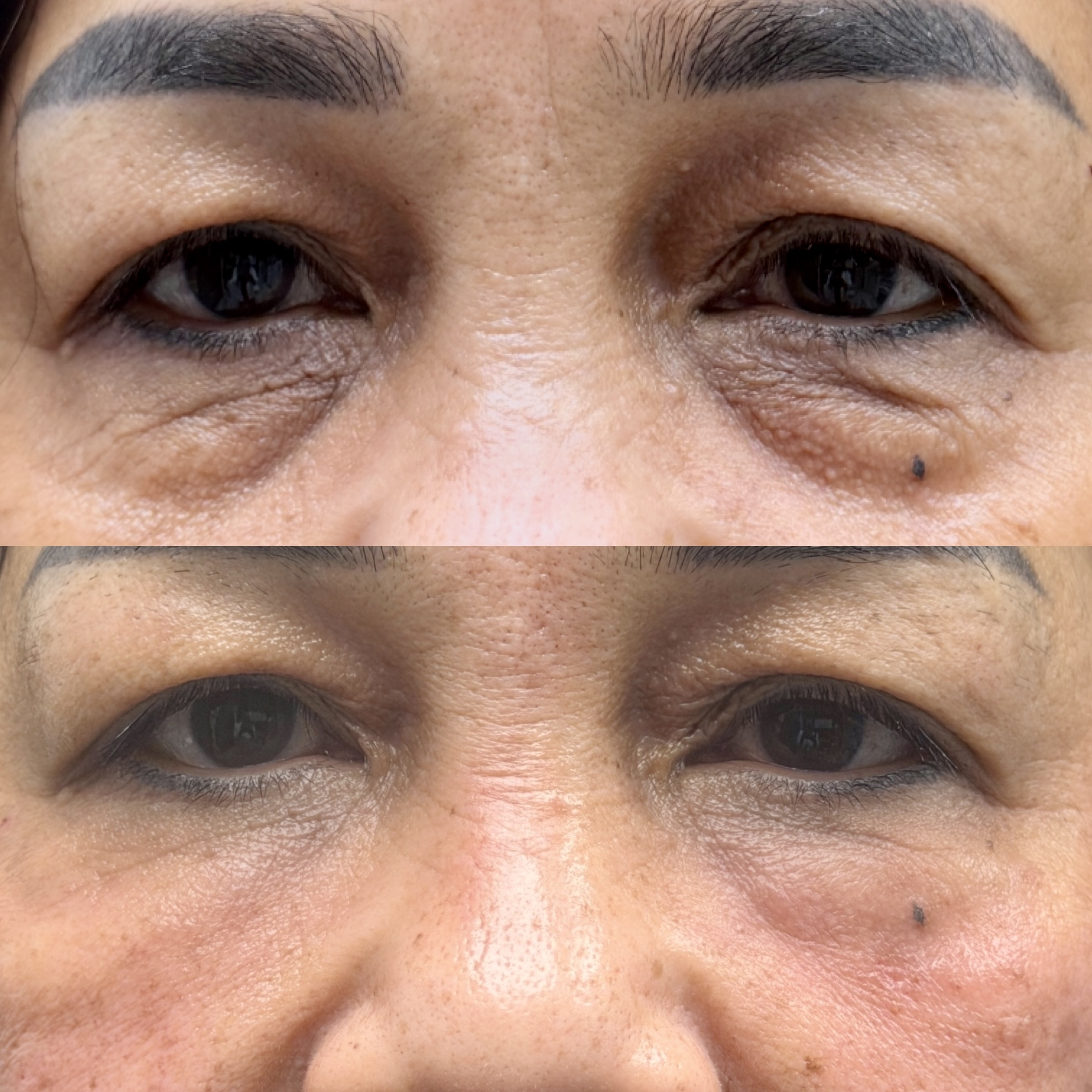PRP before and after, GlowHaus Skin & Wellness, Allen TX