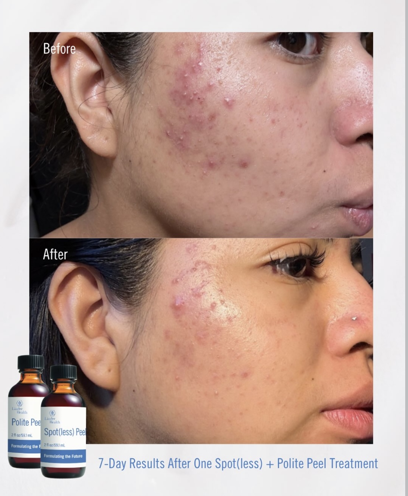 Facials & Peels before and after, GlowHaus Skin & Wellness, Allen TX