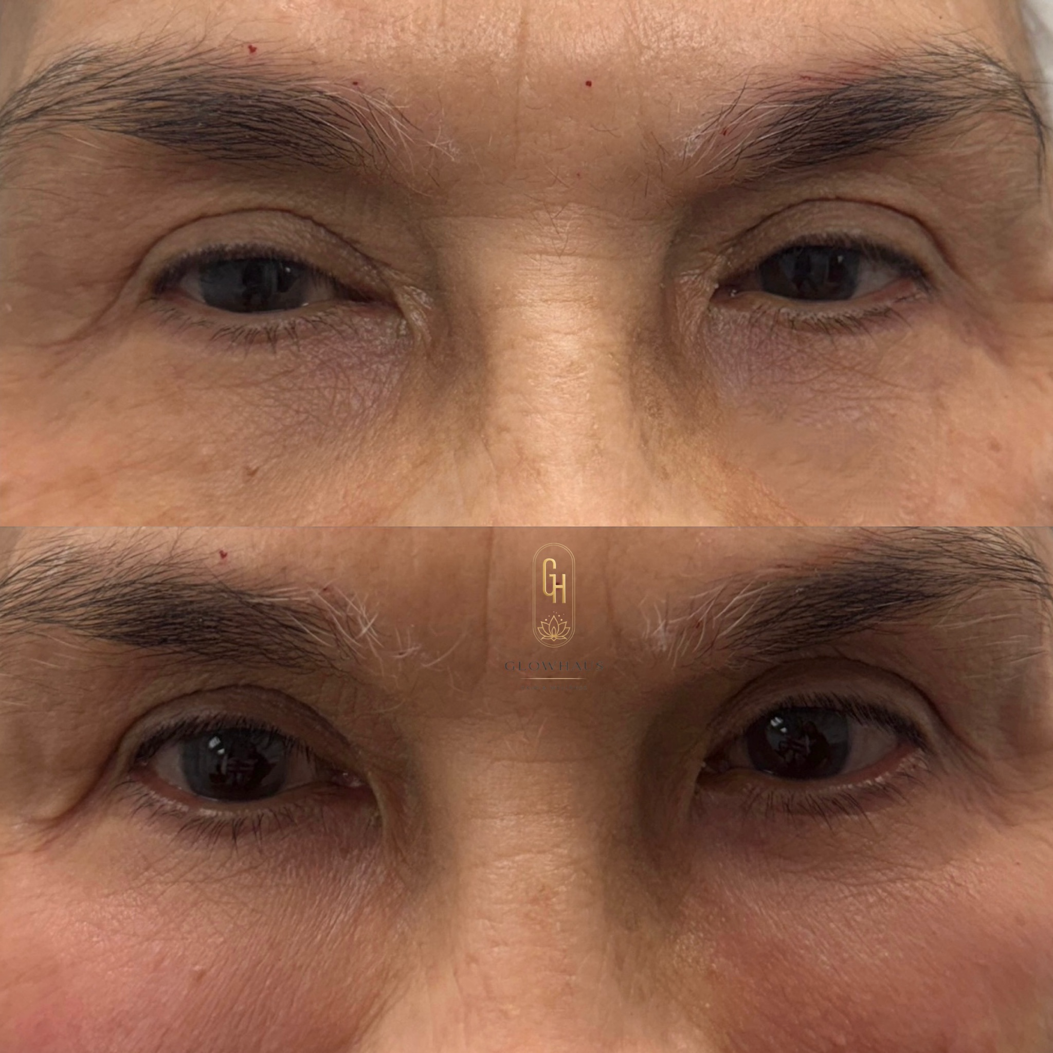 PRP before and after, GlowHaus Skin & Wellness, Allen TX