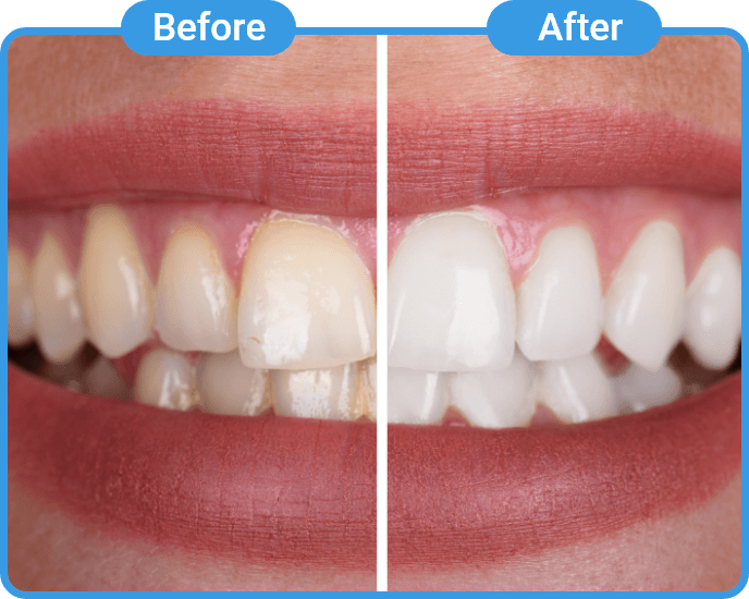 Dental Cleaning Before and After