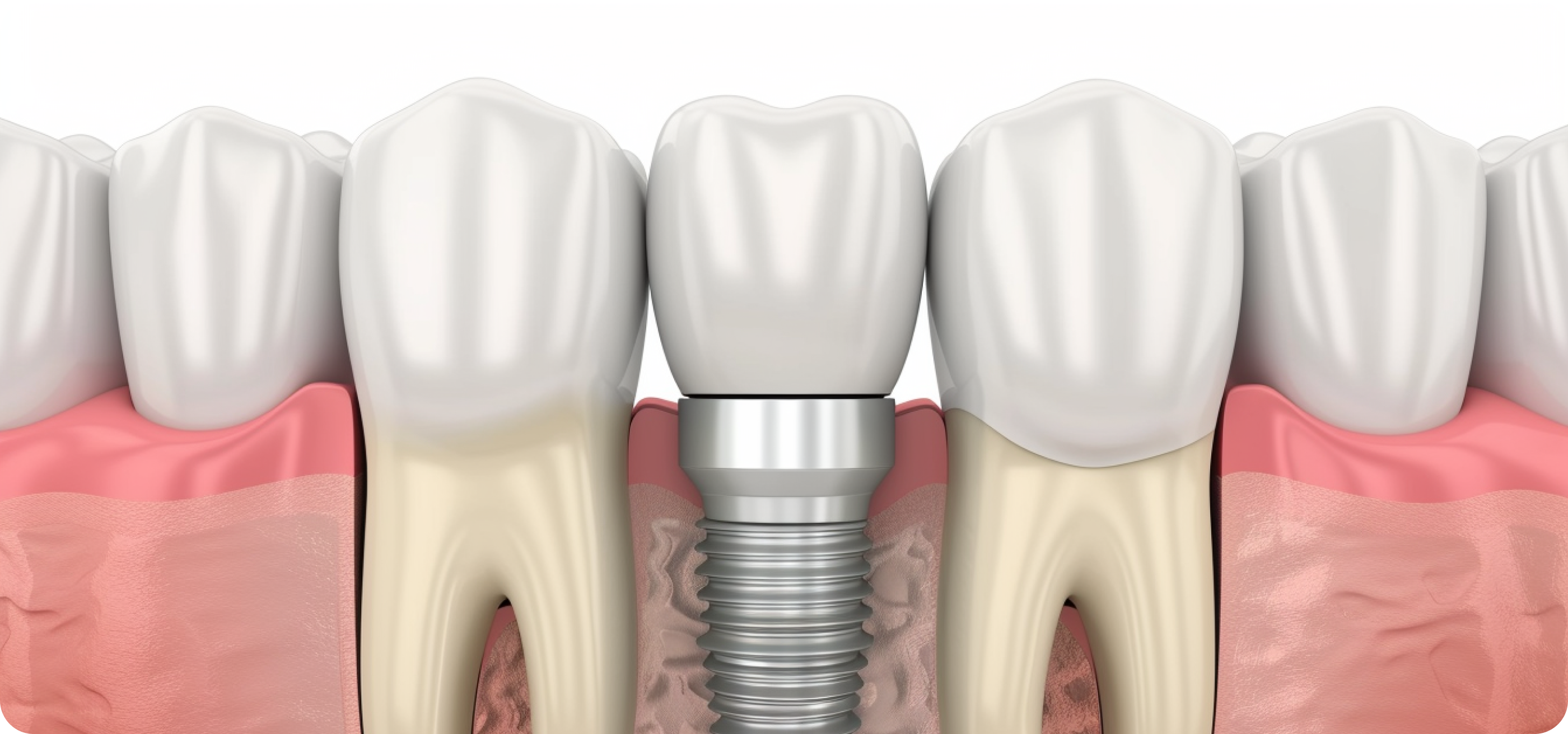 illustration of a dental implant with metal screw post positioned between natural teeth