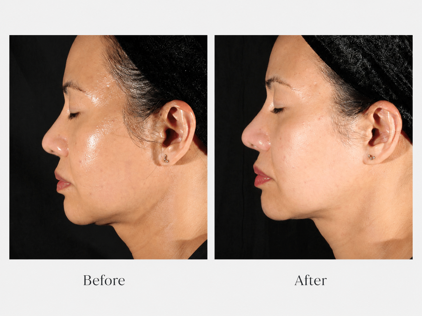 XERF Before and After - Face profile
