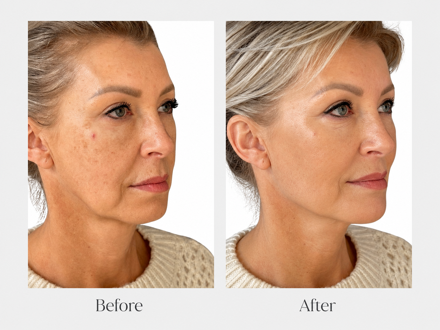 XERF Before and After - Face angle
