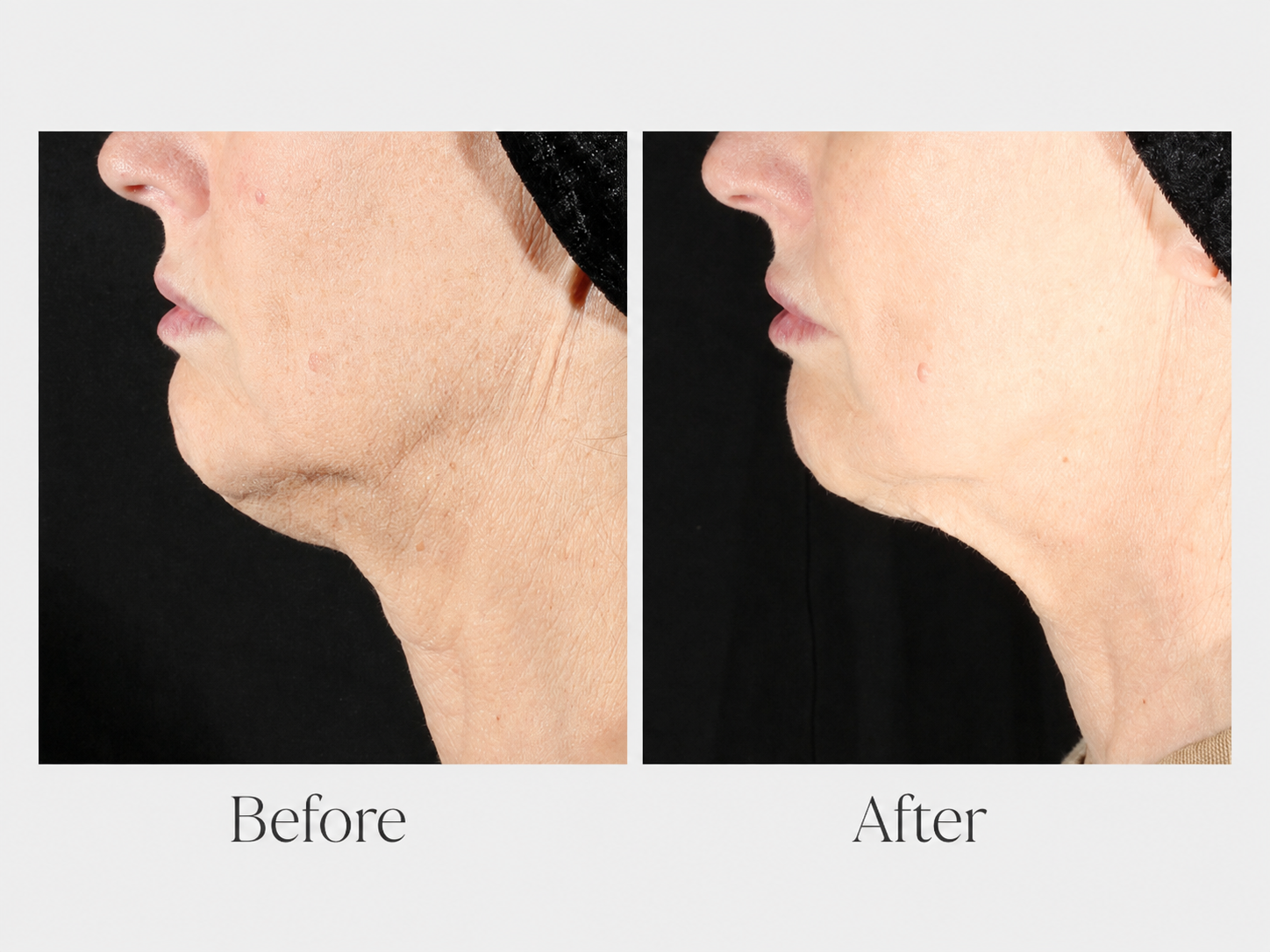 XERF Before and After - Chin and neck