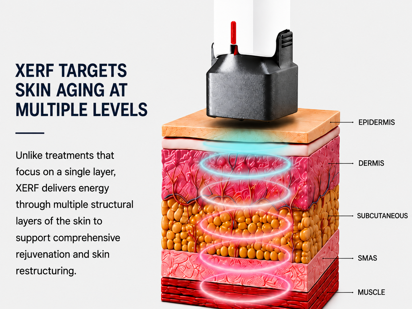 XERF targets skin aging at multiple levels - Epidermis, Dermis, Subcutaneous, SMAS, Muscle