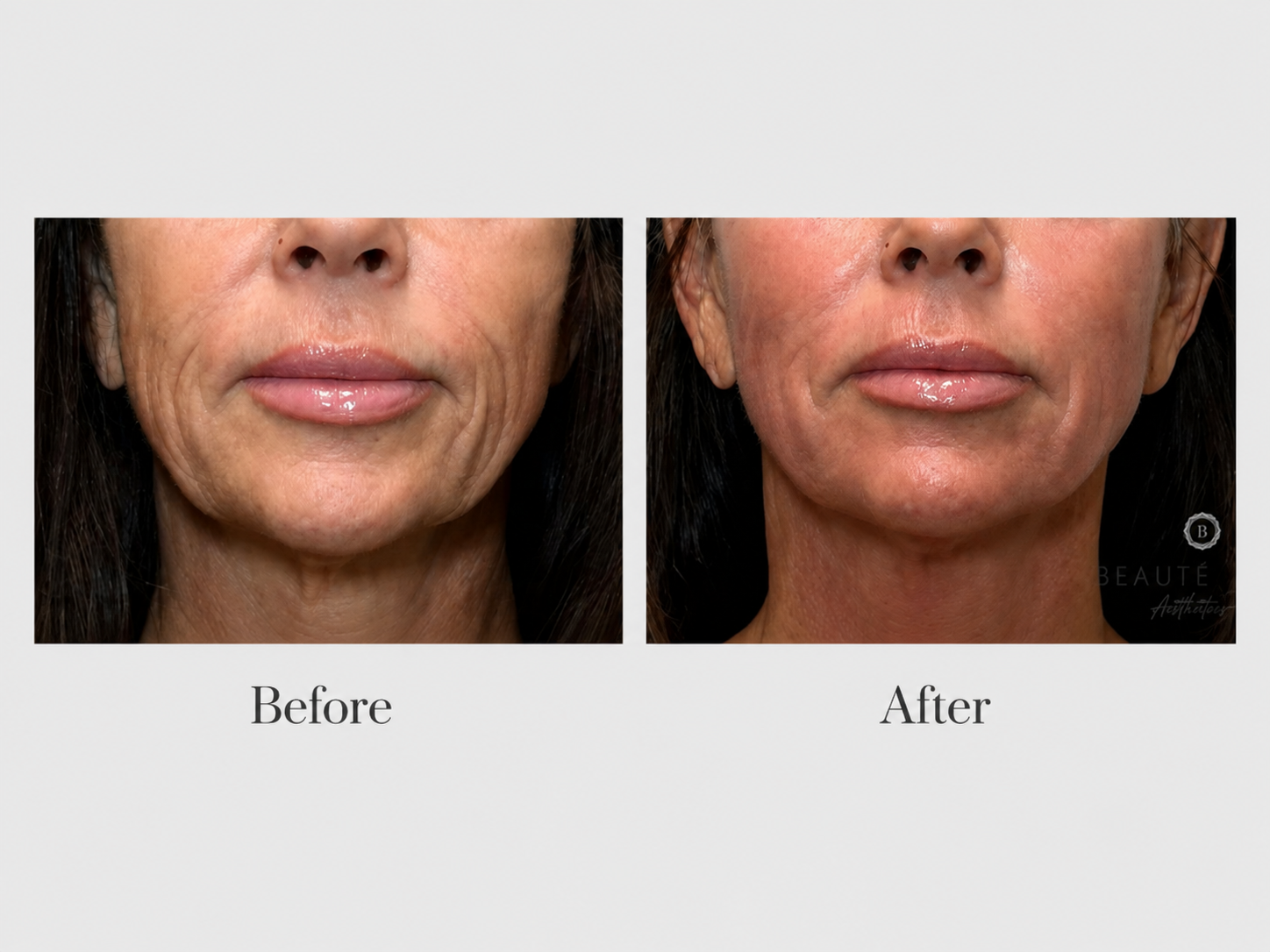 XERF Before and After - Lower face