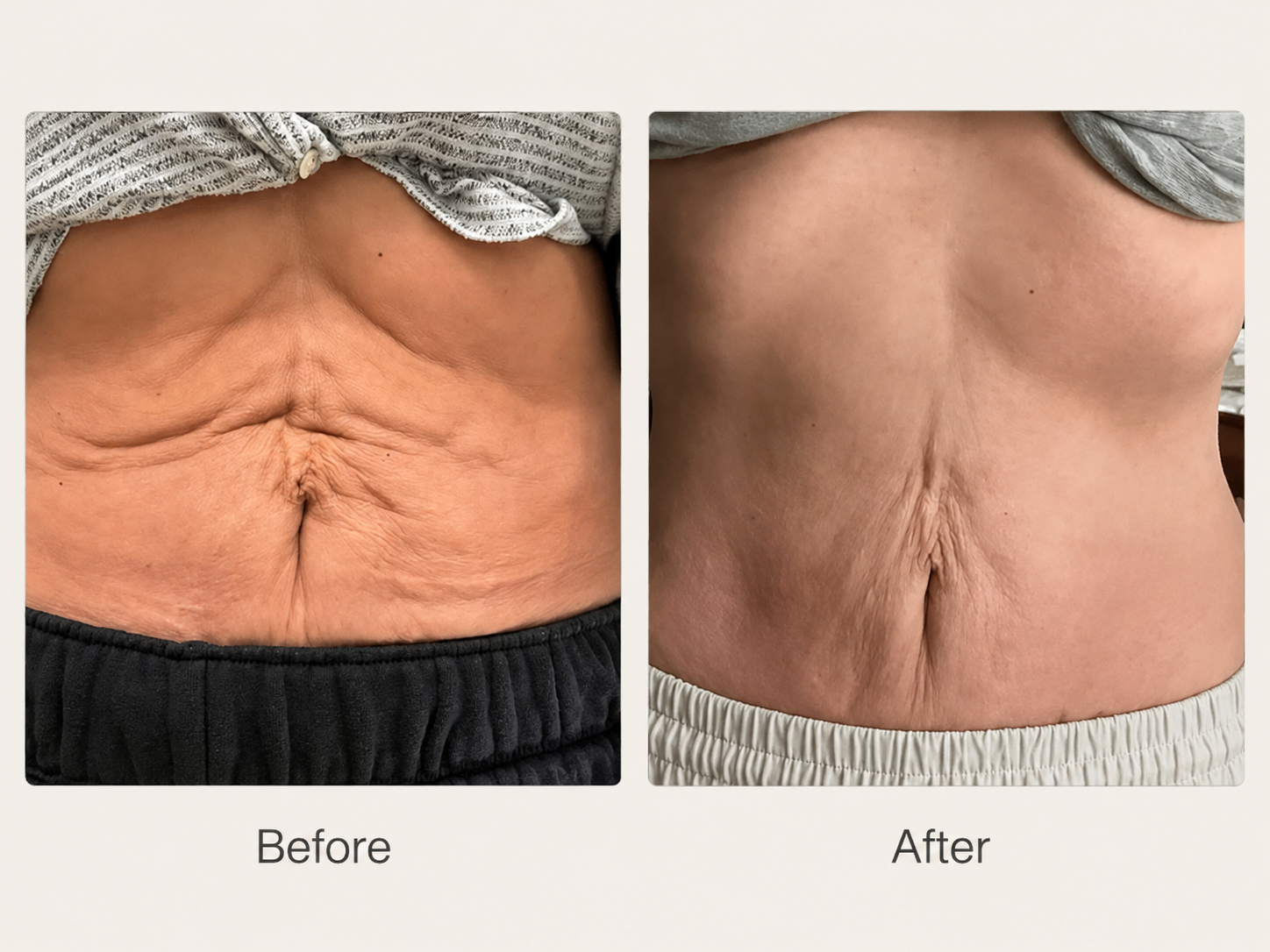 XERF Before and After - Abdomen
