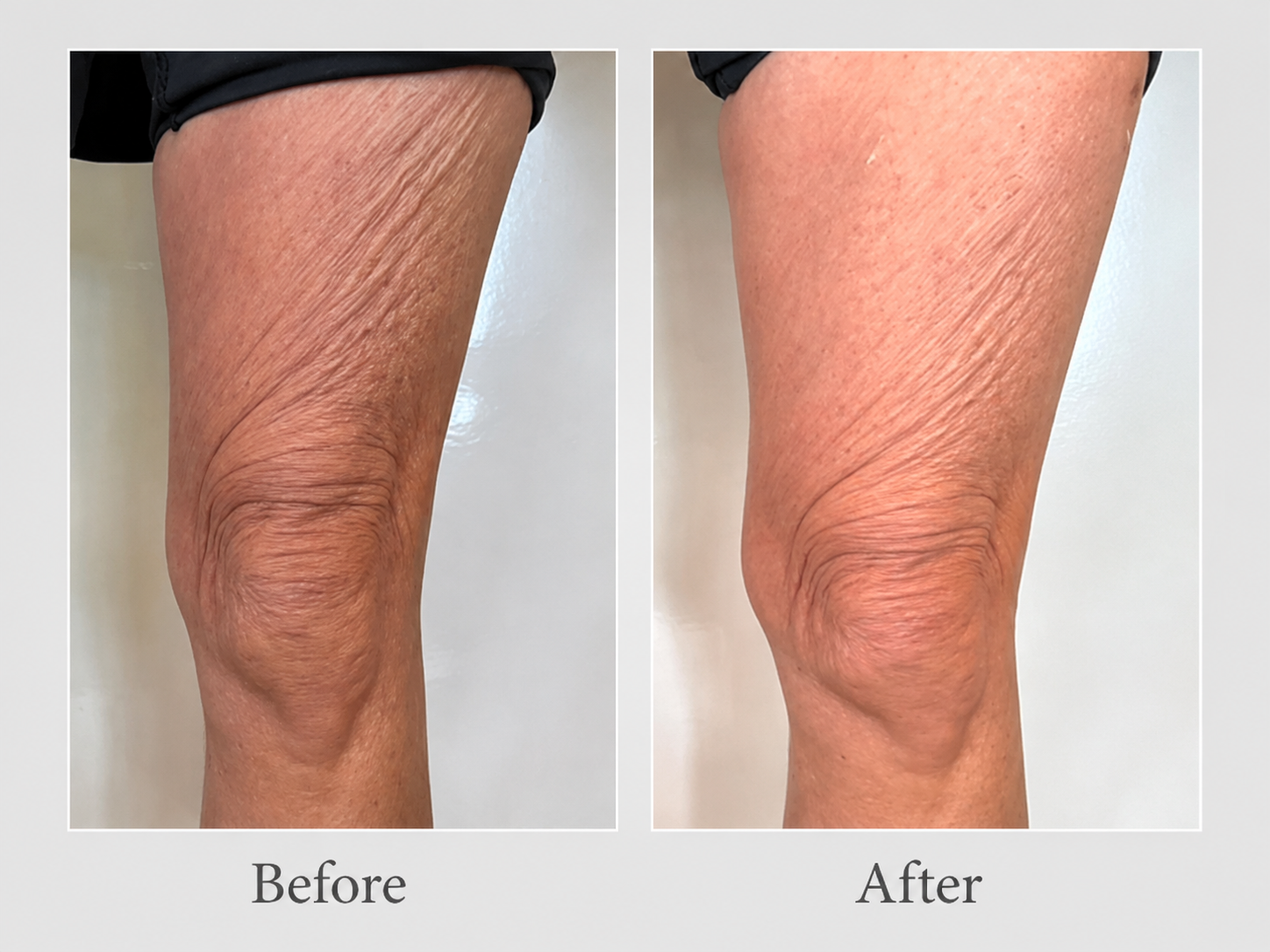 XERF Before and After - Legs