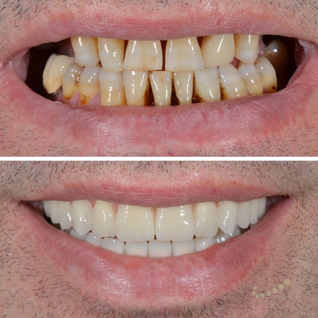 Denti fissi in ogni fase della terapia, dai provvisori ai definitivi