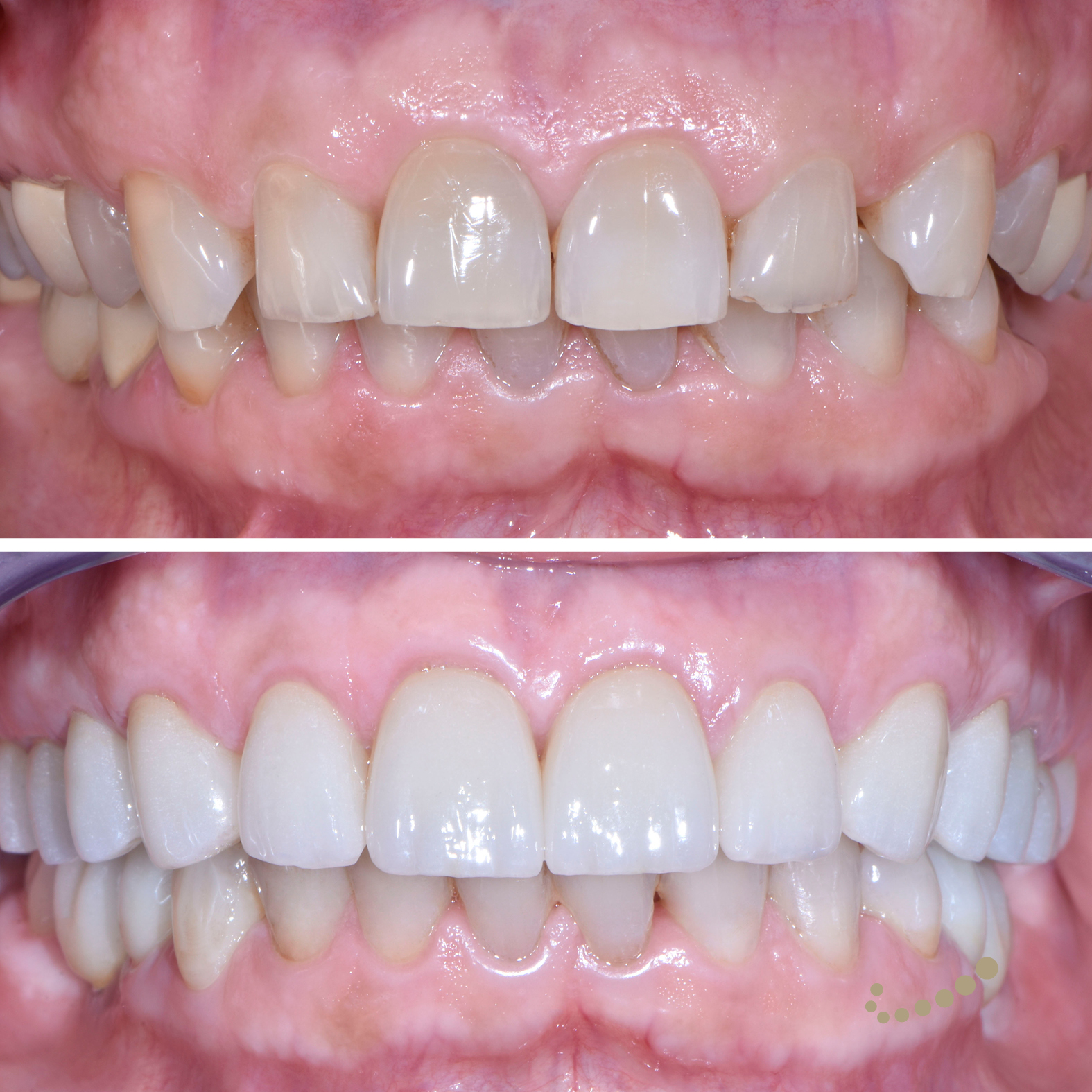 Design del sorriso dopo analisi estetica, corone dal laboratorio interno