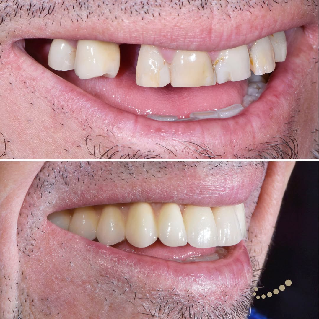 Lavoro combinato: corone in zirconia e ponte nell'arcata superiore