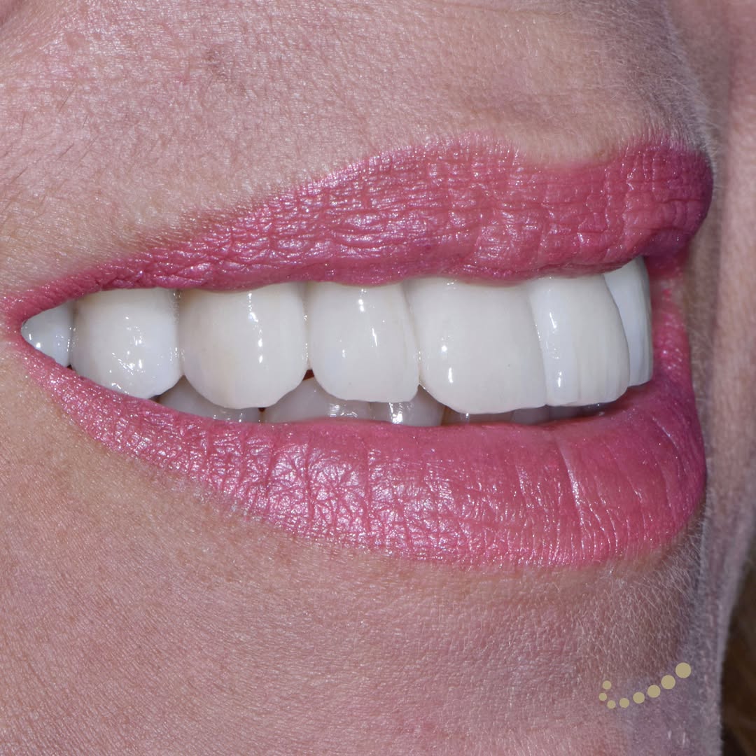 Perdita completa dei denti nell'arcata superiore, lavoro fisso su impianti