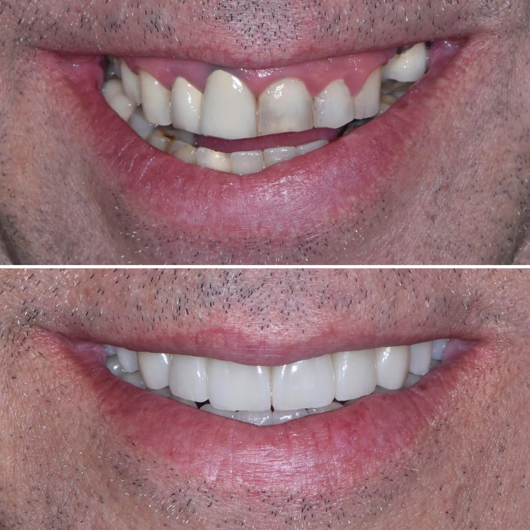 Preparazione parodontologica ed endodontica, poi impianti e nuovi denti