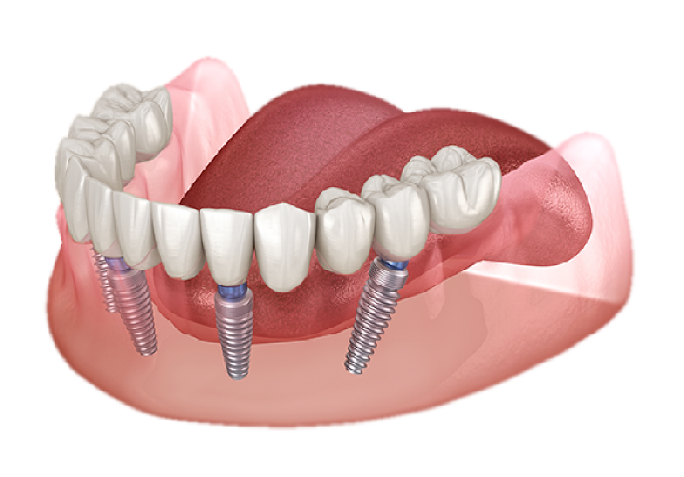 Fixed full-arch PMMA prosthesis with titanium bar on six implants