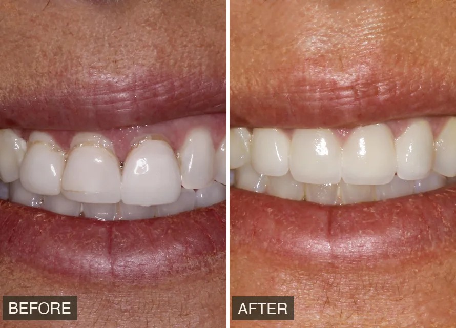 Before and after result — actual patient of Alani Smile Designers
