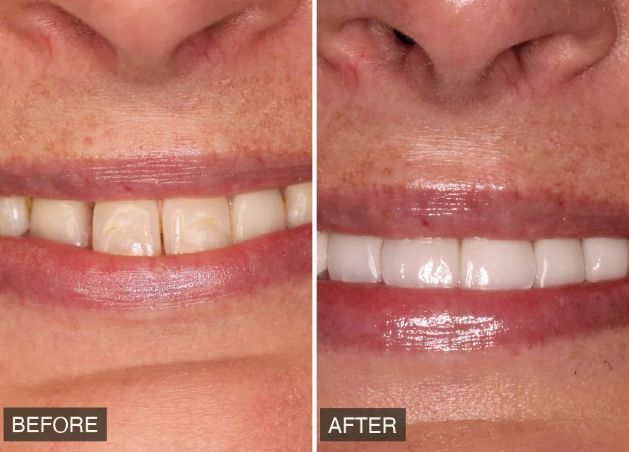 Before and after result — actual patient of Alani Smile Designers
