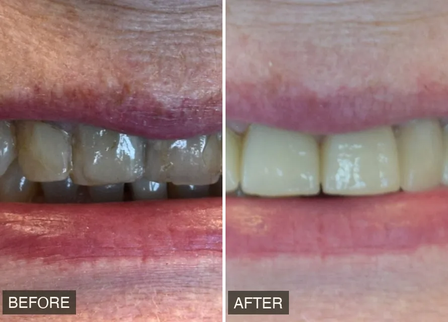 Before and after result — actual patient of Alani Smile Designers