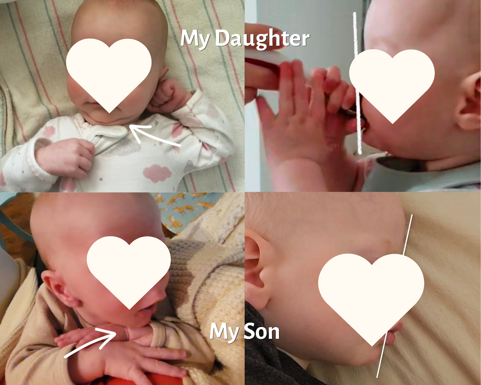 before and after baby recessed jaw transformation