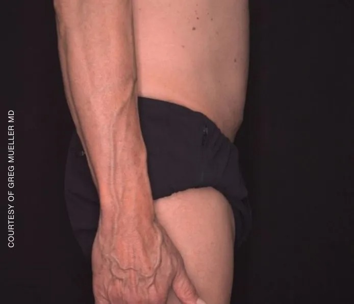 Before and after abdominal treatment at New England Aesthetics in Boston