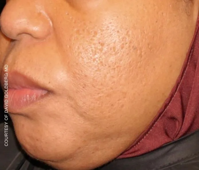 Before and after acne treatment at New England Aesthetics in Boston