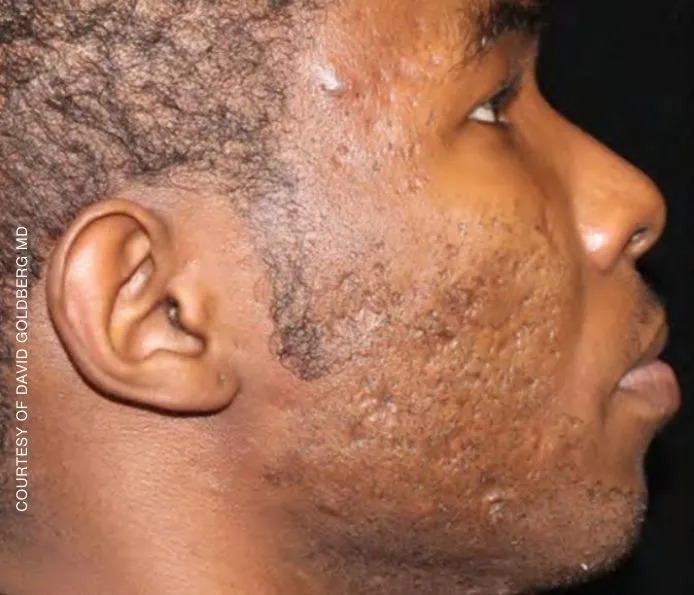 Acne & Acne-Related Texture