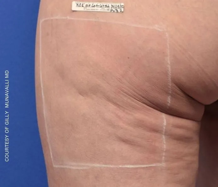 Before and after cellulite treatment at New England Aesthetics in Boston