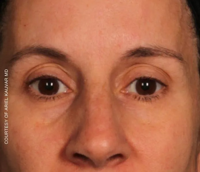 Before and after eyebrows treatment at New England Aesthetics in Boston