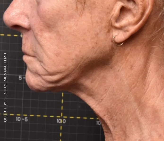 Before and after submental treatment at New England Aesthetics in Boston