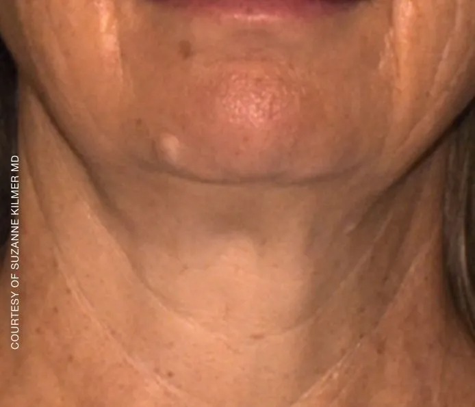 Before and after neck treatment at New England Aesthetics in Boston
