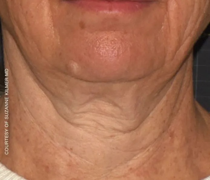Facial Volume Loss