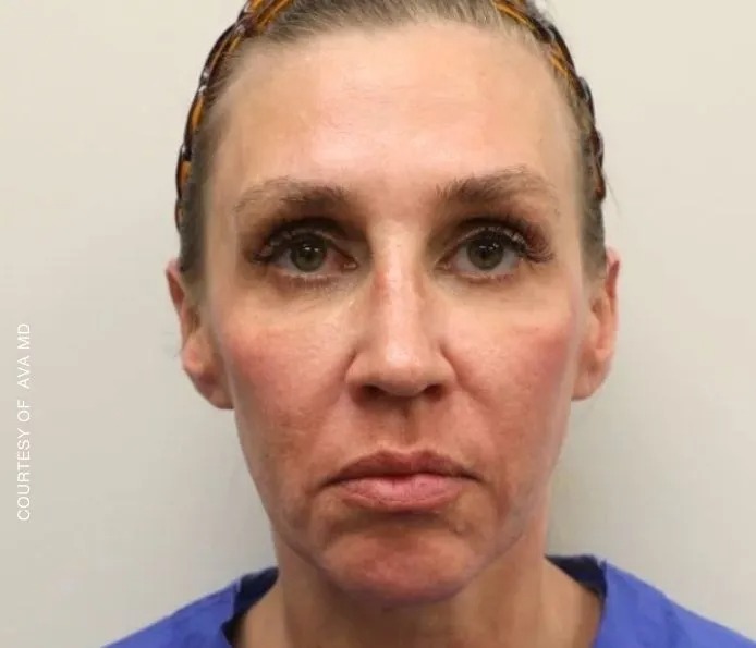 Facial Imbalance