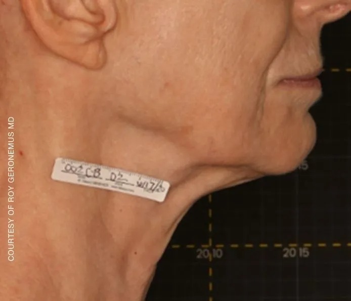 Submental Skin Laxity
