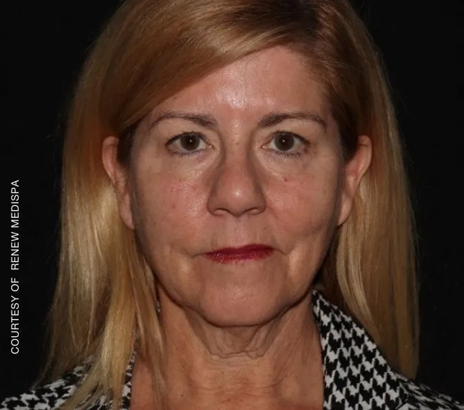 Before and after wrinkles renew treatment at New England Aesthetics in Boston