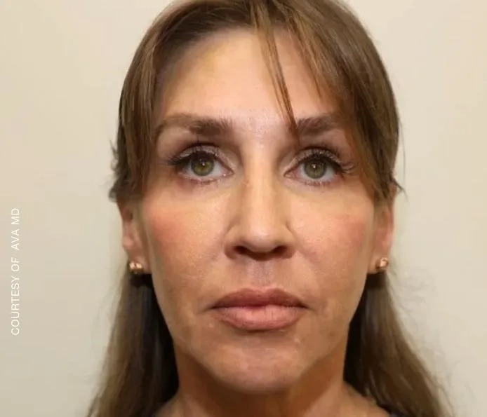 Before and after wrinkles treatment at New England Aesthetics in Boston