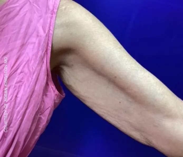 Before and after upper arm treatment at New England Aesthetics in Boston