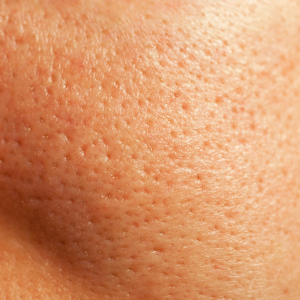Uneven Skin Texture