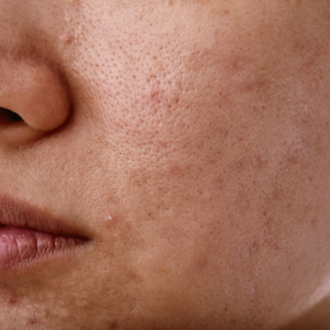 Dull or Tired-Looking Skin