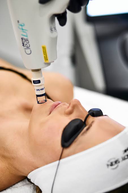 ClearLift non-ablative laser treatment for facial skin rejuvenation