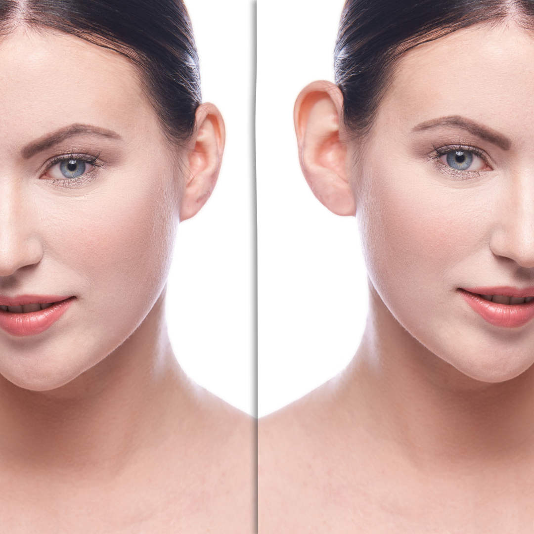 Fülplasztika – EA Beauty Medical