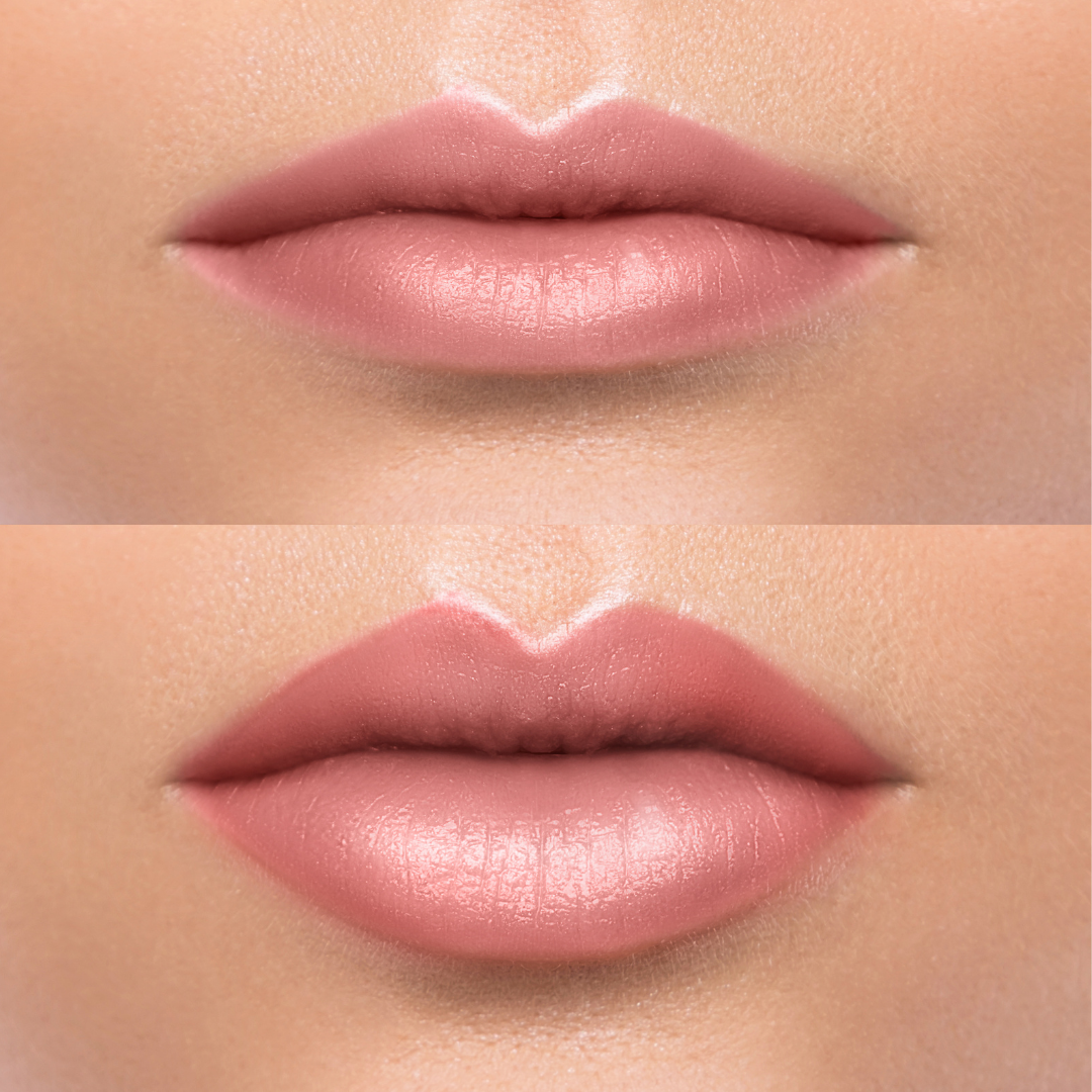 Ajakfelvarrás – Bull Horn Lip Lift – EA Beauty Medical
