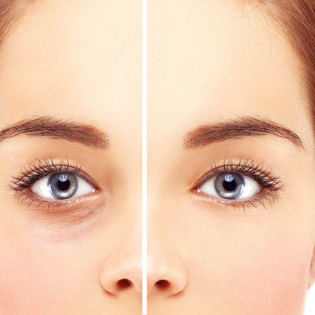 Alsó szemhéjplasztika – EA Beauty Medical