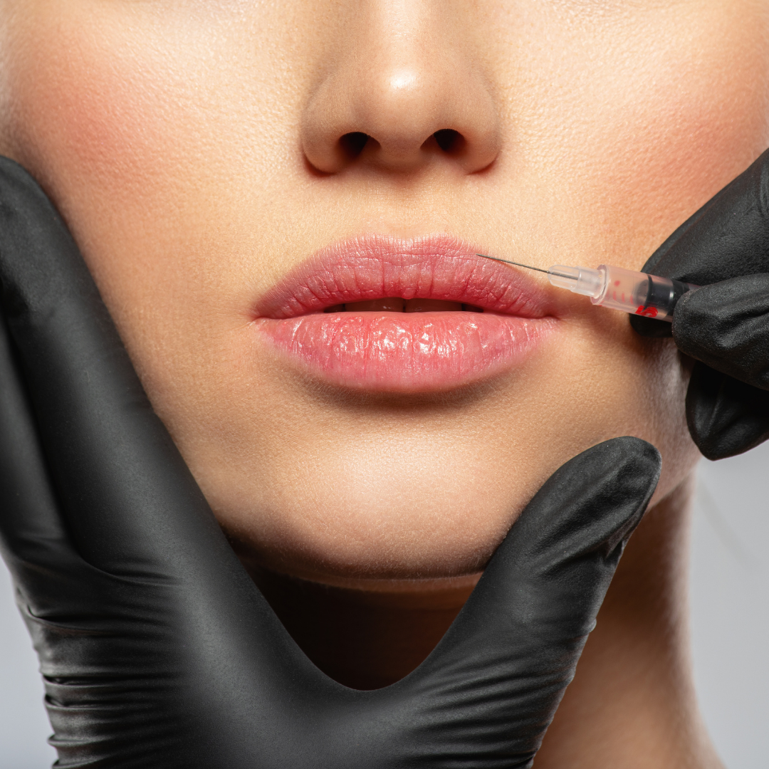 Lip Flip botox – EA Beauty Medical