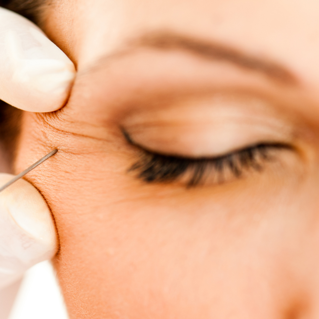 Fox Eye Botox – EA Beauty Medical